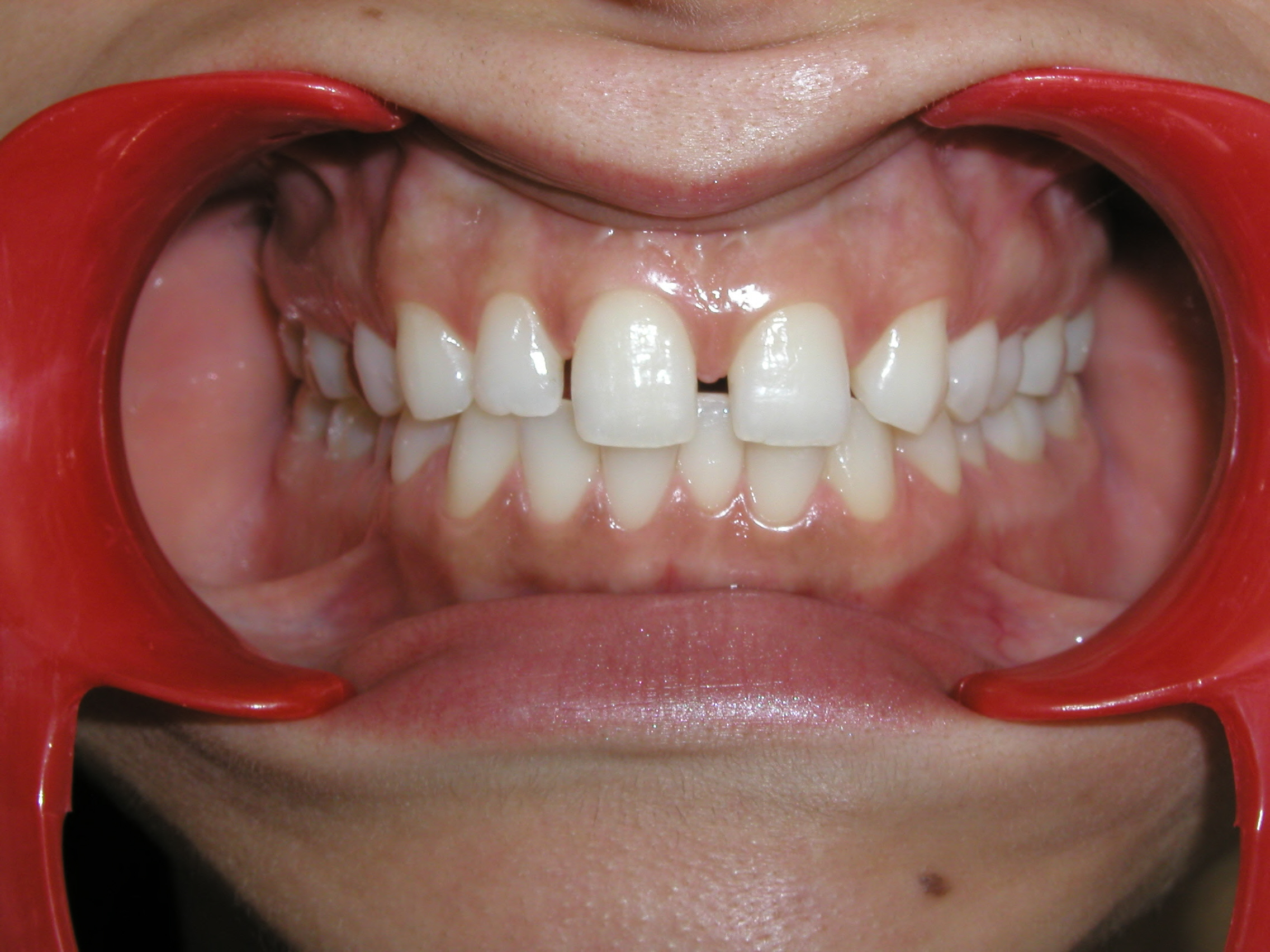 Zahnkorrektur 1